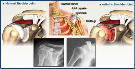 Homeopathy for athritis in Dubai