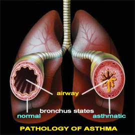 Homeopathy for asthma